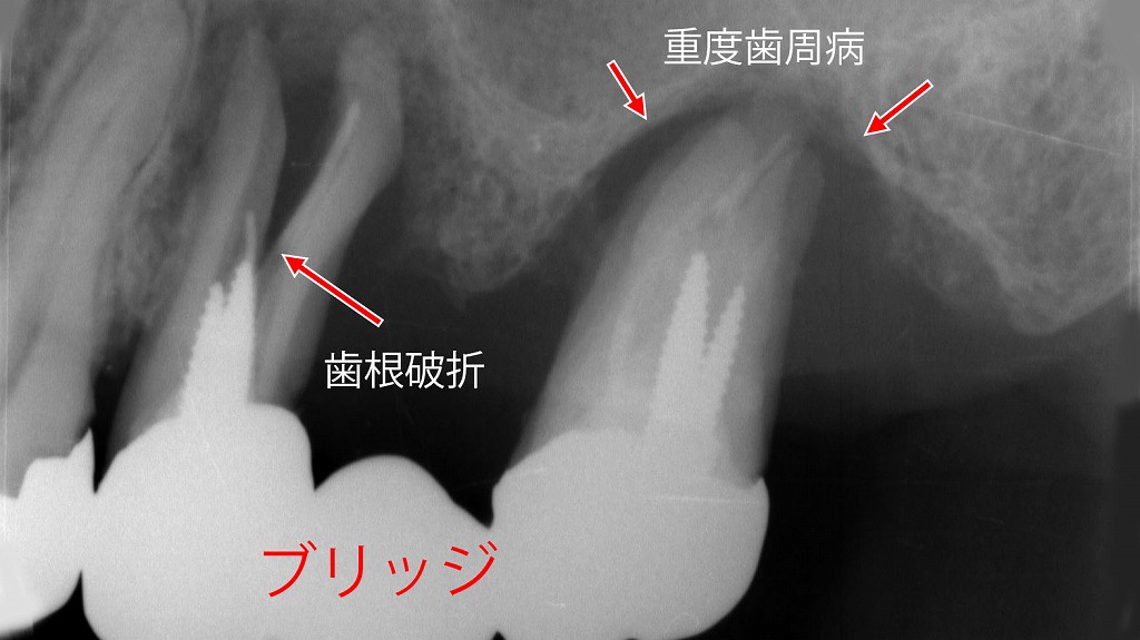 歯周病によるグラつきと歯根破折のX線所見