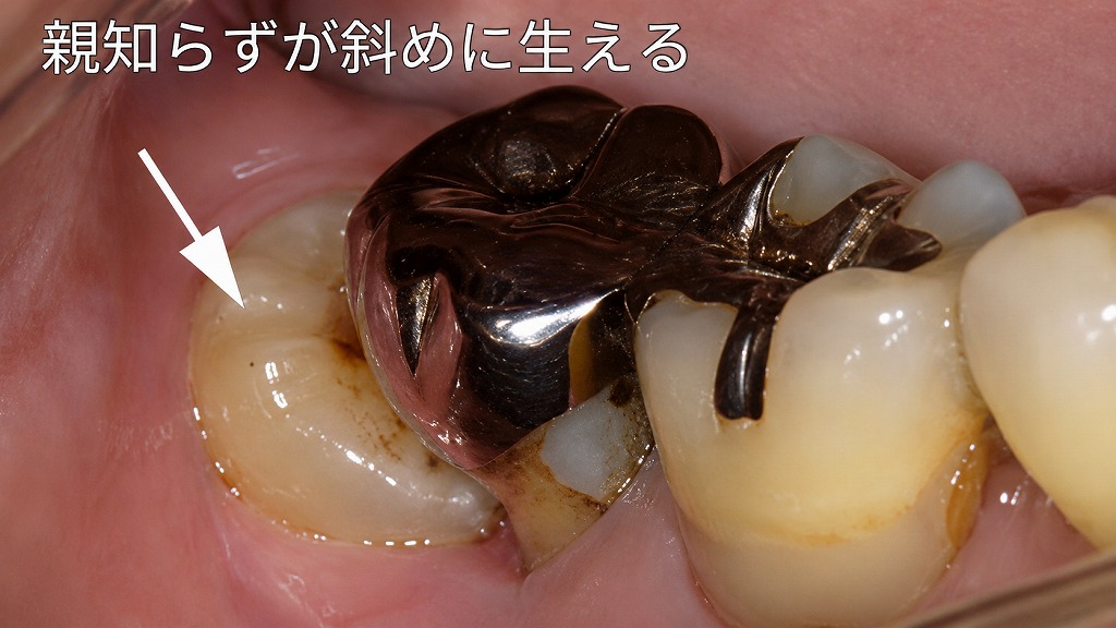部分萌出：斜めに生えた親知らずが招くトラブル｜隣の歯の虫歯リスクが上昇