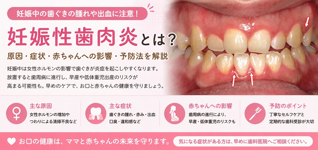 妊娠性歯肉炎とは