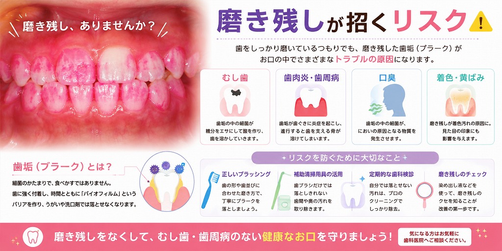 磨き残しが招くリスク