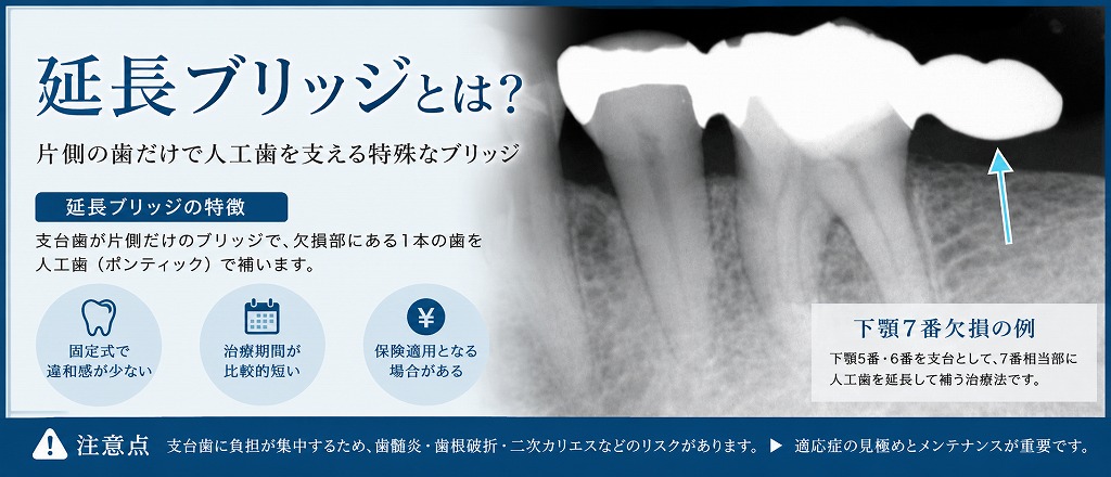 延長ブリッジとは
