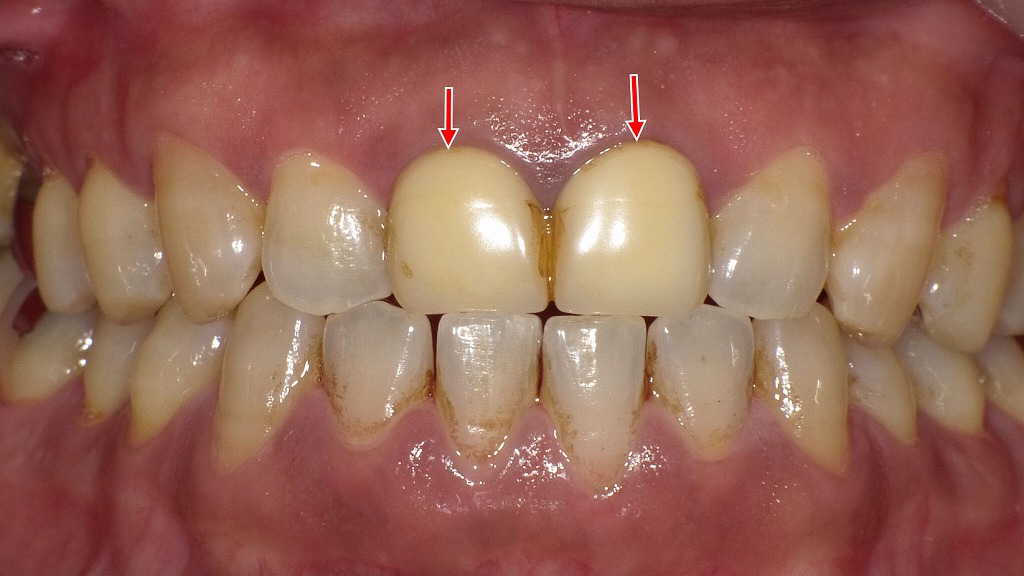 上顎1・1番の硬質レジン前装冠｜経年による変色・艶消失・着色