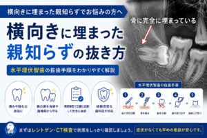 横向きに埋まった親知らずの抜き方｜水平埋伏智歯の抜歯手順