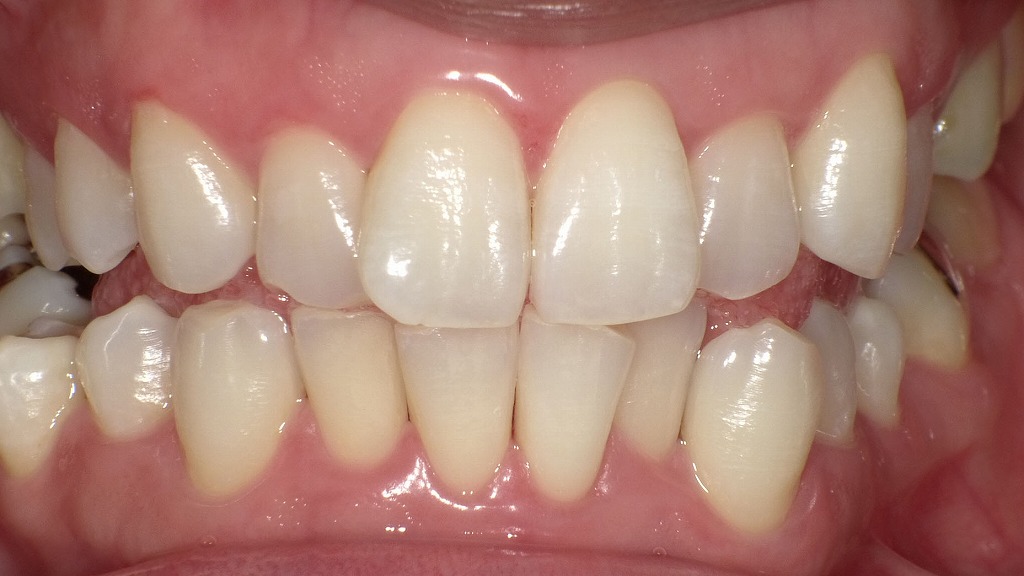 画像②：ホワイトニング後