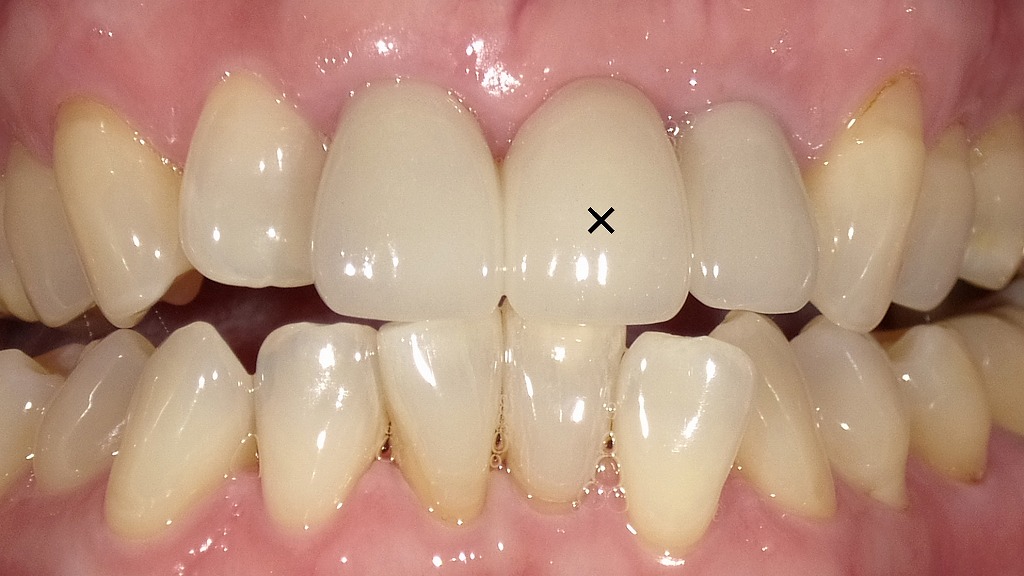 メタルボンドブリッジによる前歯部の欠損補綴(上顎1・1・2番連結ブリッジ)×印は欠損歯でブリッジのダミー(ポンティック)