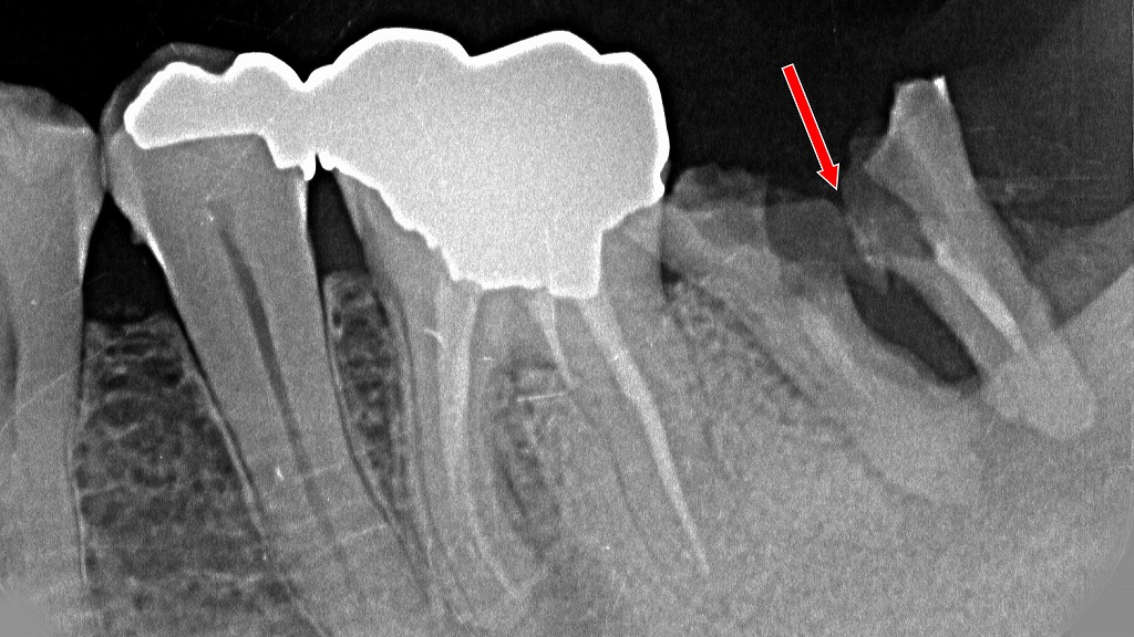 重度の歯根破折では抜歯が必要になることも