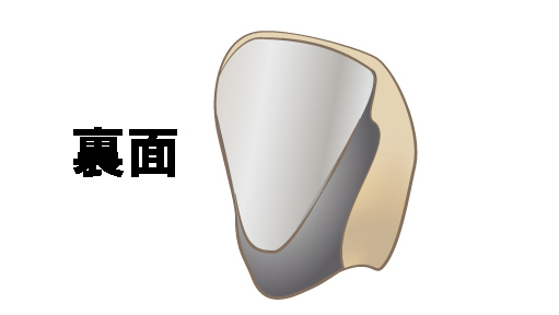 硬質レジン前装冠の裏側。金属フレームの上にレジンが貼り付けられた構造になっており、強度と見た目を両立させている。