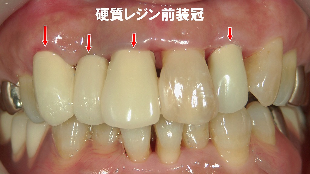 保険の硬質レジン前装冠（赤矢印）が装着されている例。中央の天然歯との色の差が確認できます。