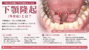 下顎内側の固い膨らみ下顎隆起