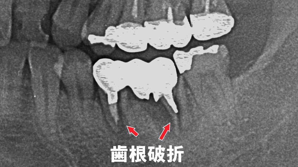 ヘミセクション後に起こりうるリスク：支台歯の歯根破折