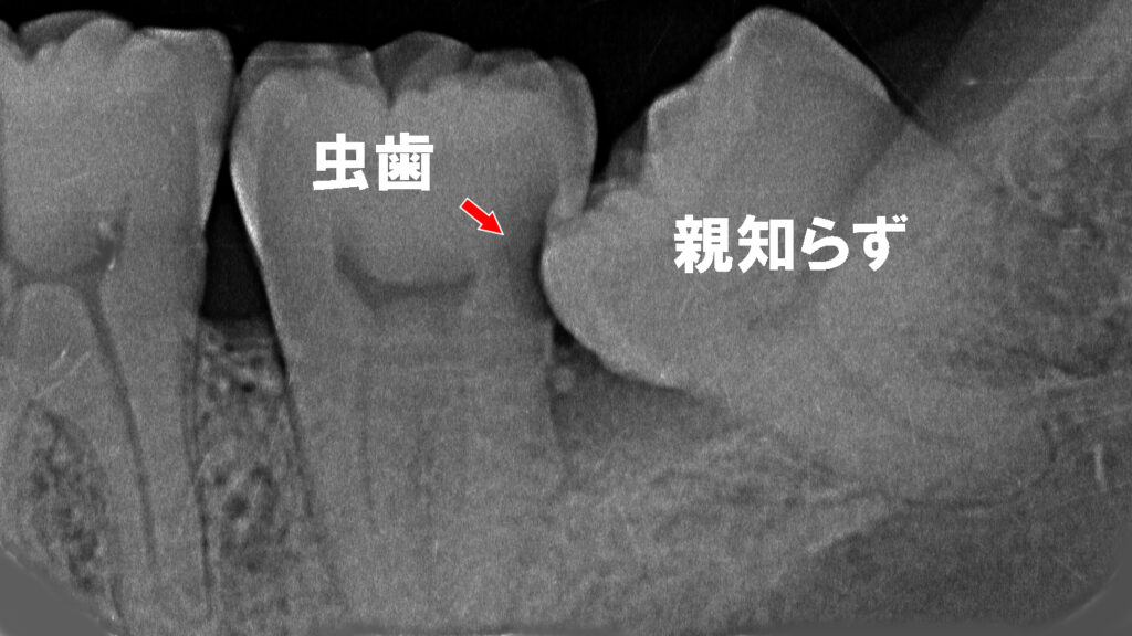 水平埋伏智歯を放置すると起こる問題|隣接面う蝕の進行リスク