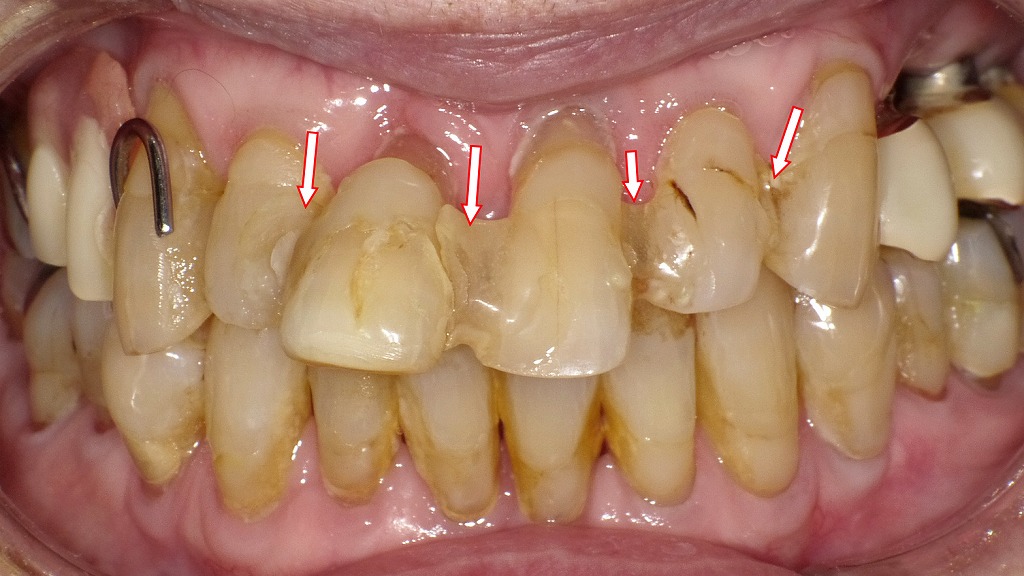 前歯を暫間固定した症例