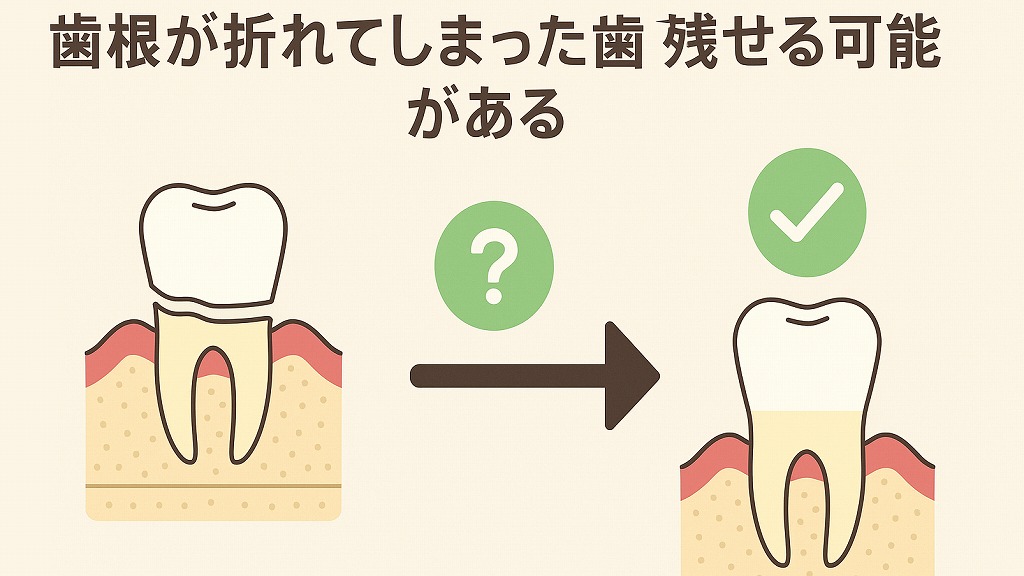 「前歯が折れたら抜歯しかない?」残せる可能性と治療の選択肢を解説