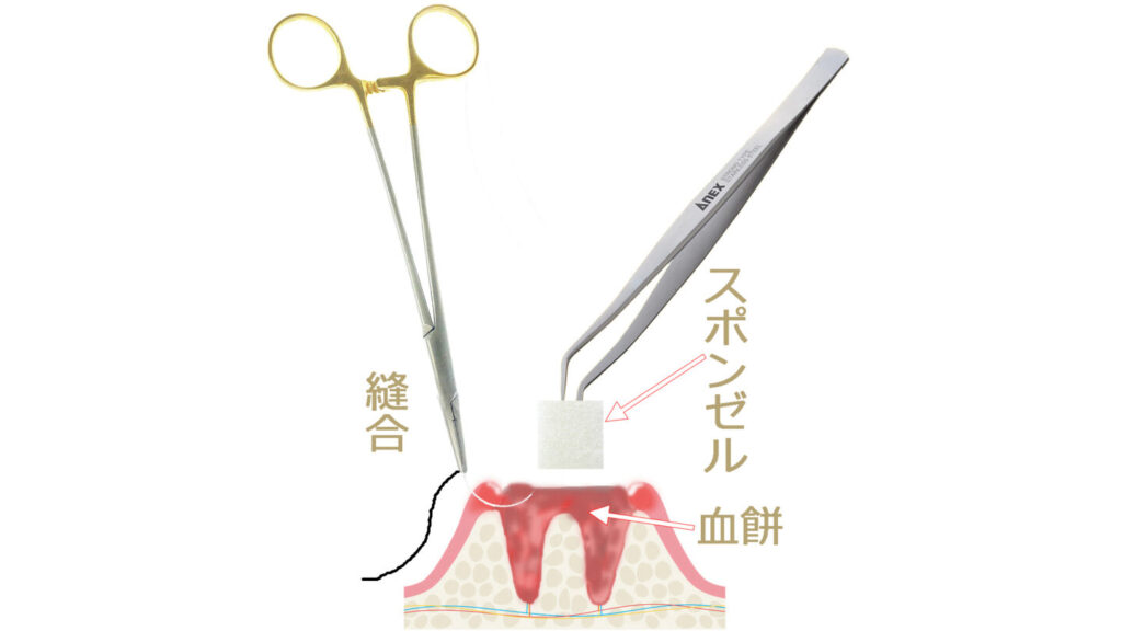 スポンゼル(止血剤)