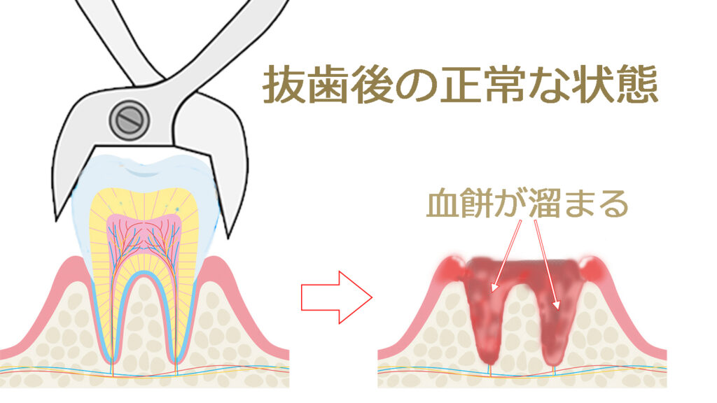 抜歯後に血餅が出来る