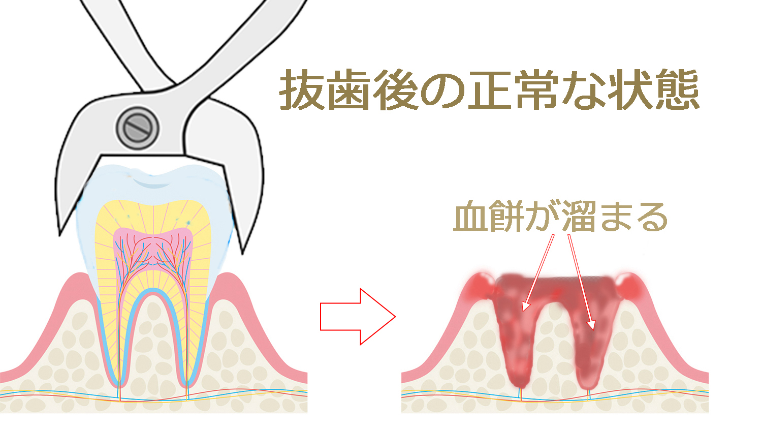 抜歯後の血餅が取れたら？ドライソケット予防と対処法まとめ