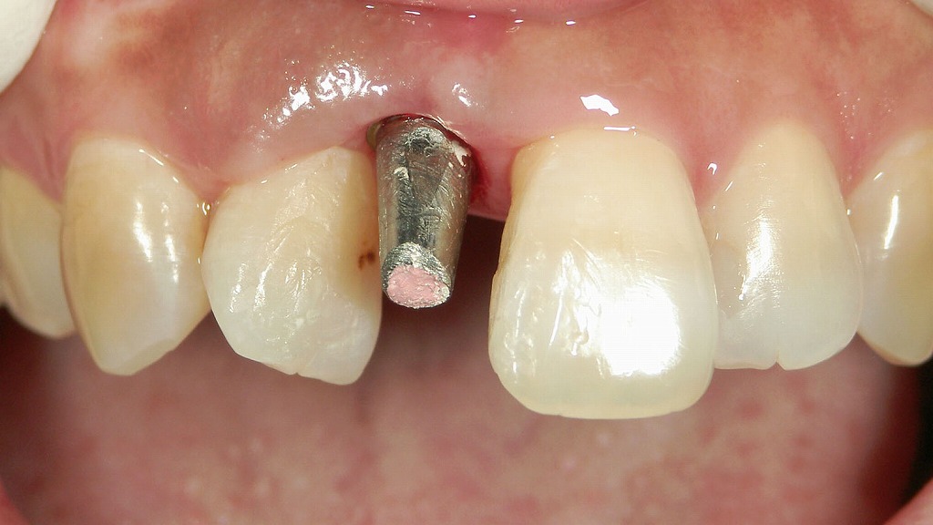 アバットメント（土台）