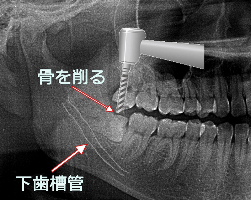 歯ぐきの切開や骨の削除