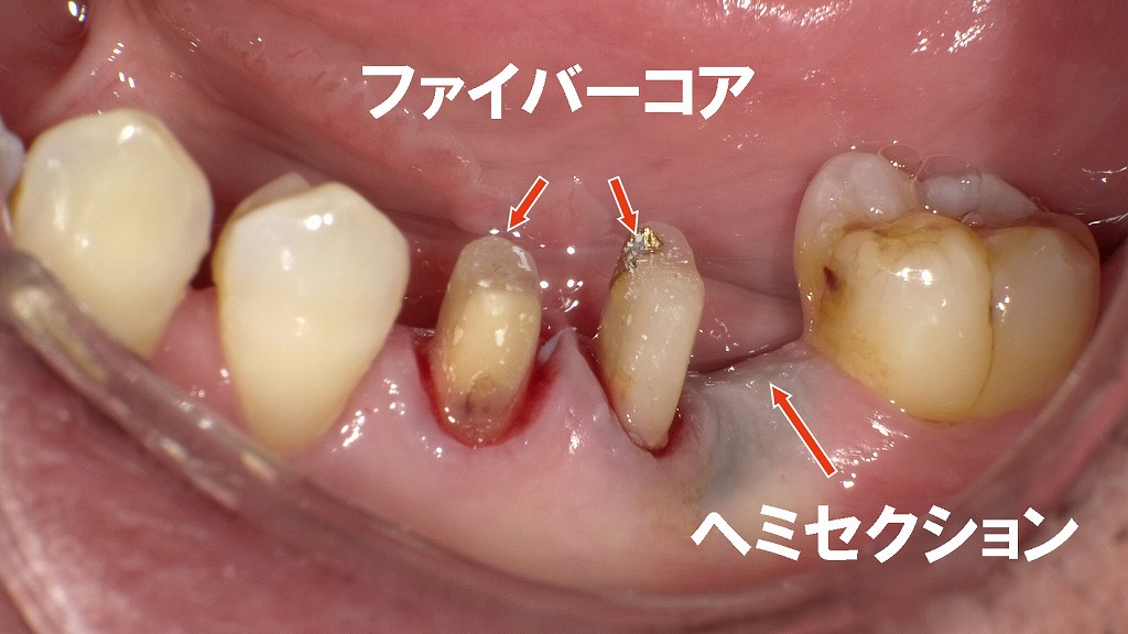 5番・6番近心根にファイバーコア