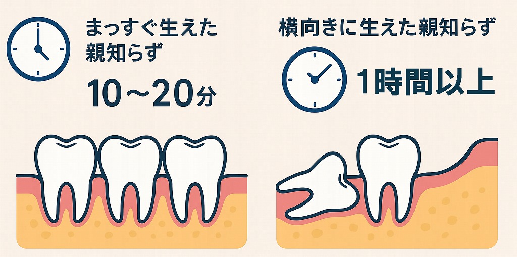 親知らずの抜歯パターン別|時間の目安