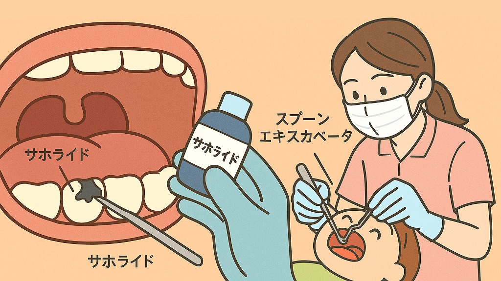 幼児の虫歯は“鎮火”を目的に