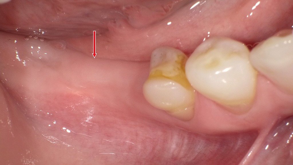 下顎6番・7番が欠損し、現在は入れ歯で対応している部位。長期的な咀嚼機能の回復を目的に、インプラント治療への移行が検討されるケース。欠損部には骨量や粘膜の状態を確認し、適切な埋入位置を診断していく。