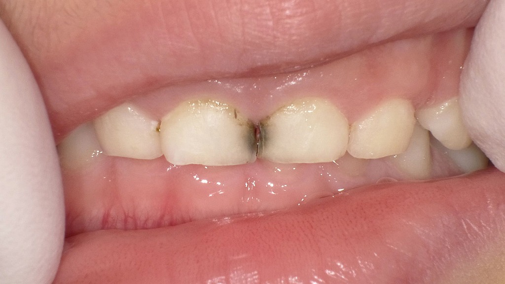 サホライド塗布１回目