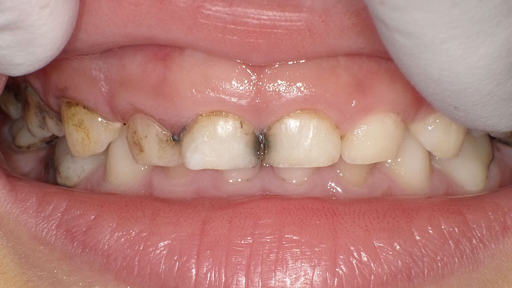 サホライド塗布３回目（半年後）