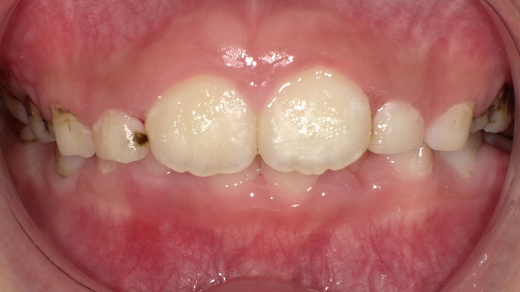 A・A脱落後に1・1番が萌出｜プラークコントロール不良の状態