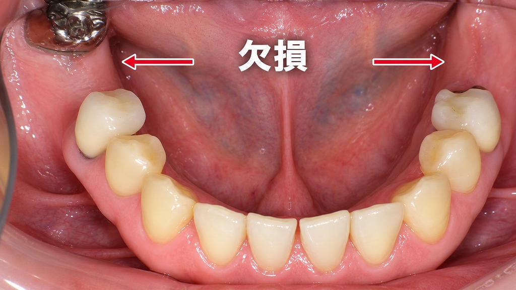 術前:欠損状態