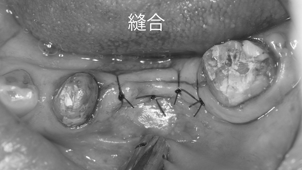下顎5・6番部インプラント手術 ― 縫合完了後の術後所見