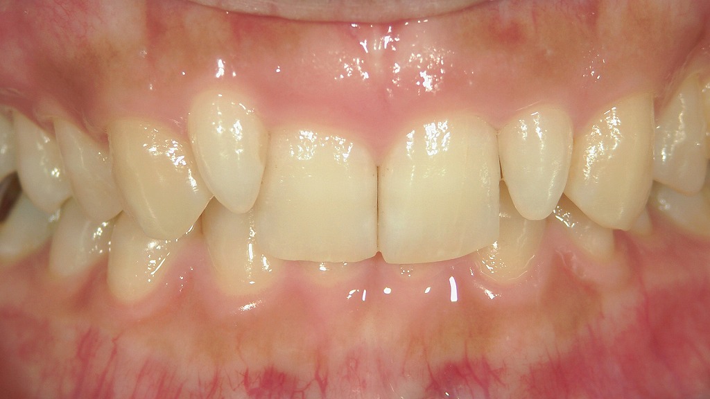 過蓋咬合（ディープバイト）