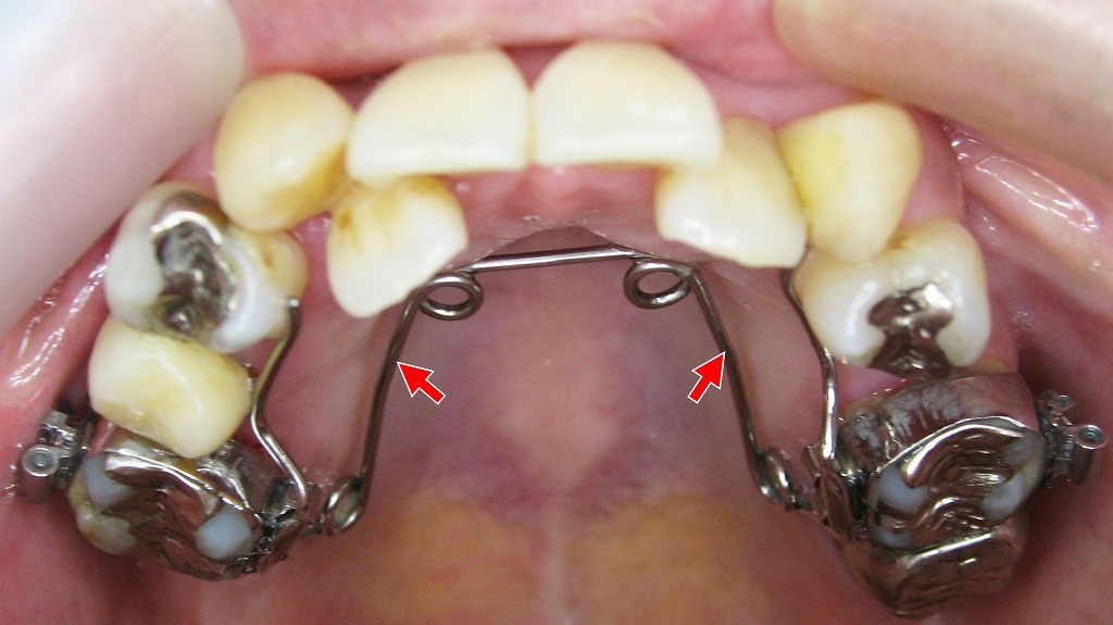 上顎をやさしく拡大する矯正装置「クワドヘリックス」