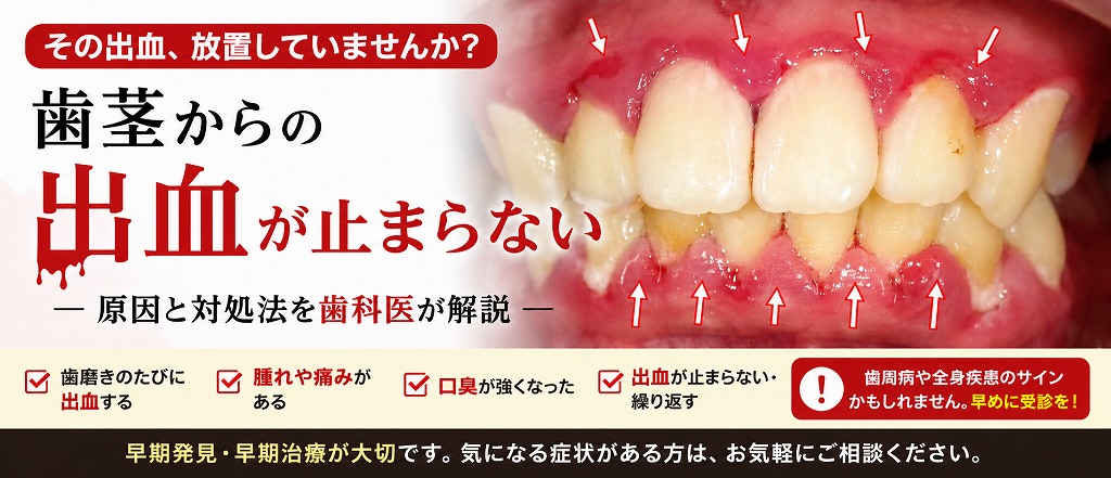 歯茎からの出血が止まらない
