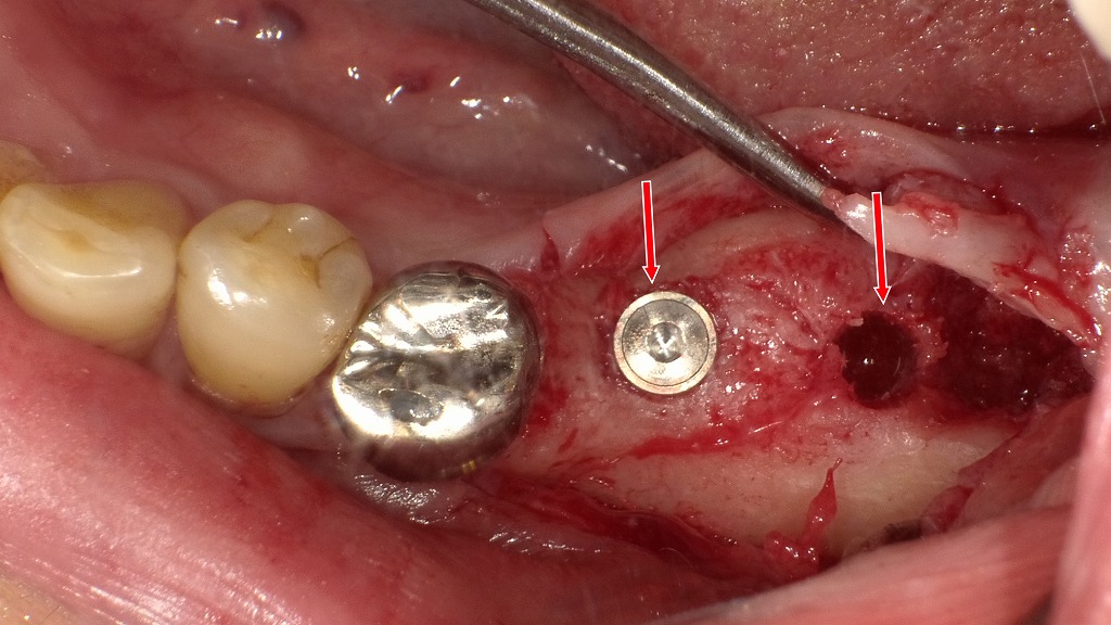 術中：インプラント埋入手術