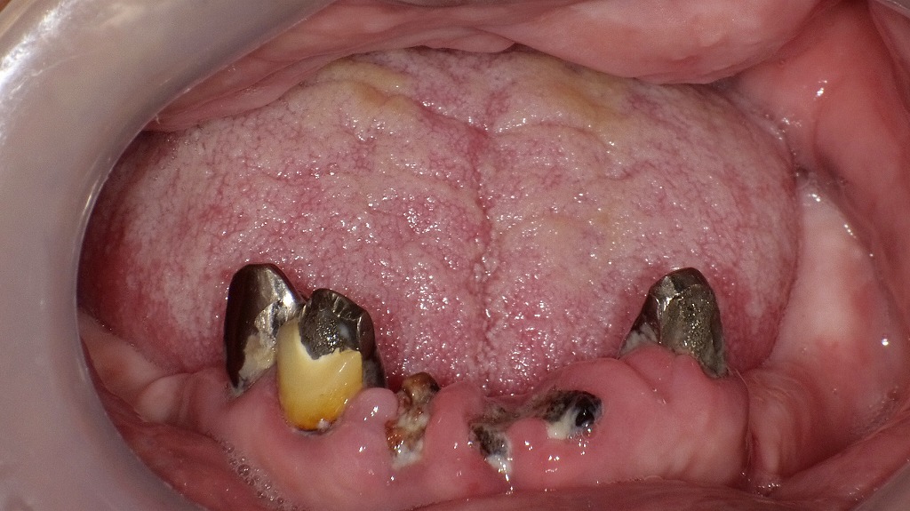 歯の喪失とう蝕・歯周病の進行例