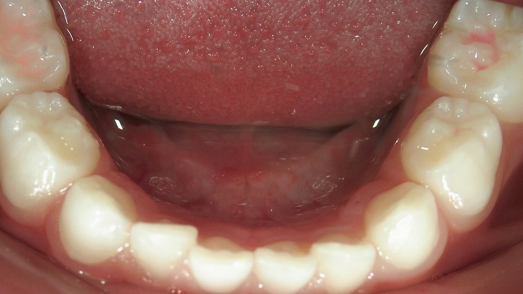 下の乳前歯も隙間がなくキュッと詰まった歯列