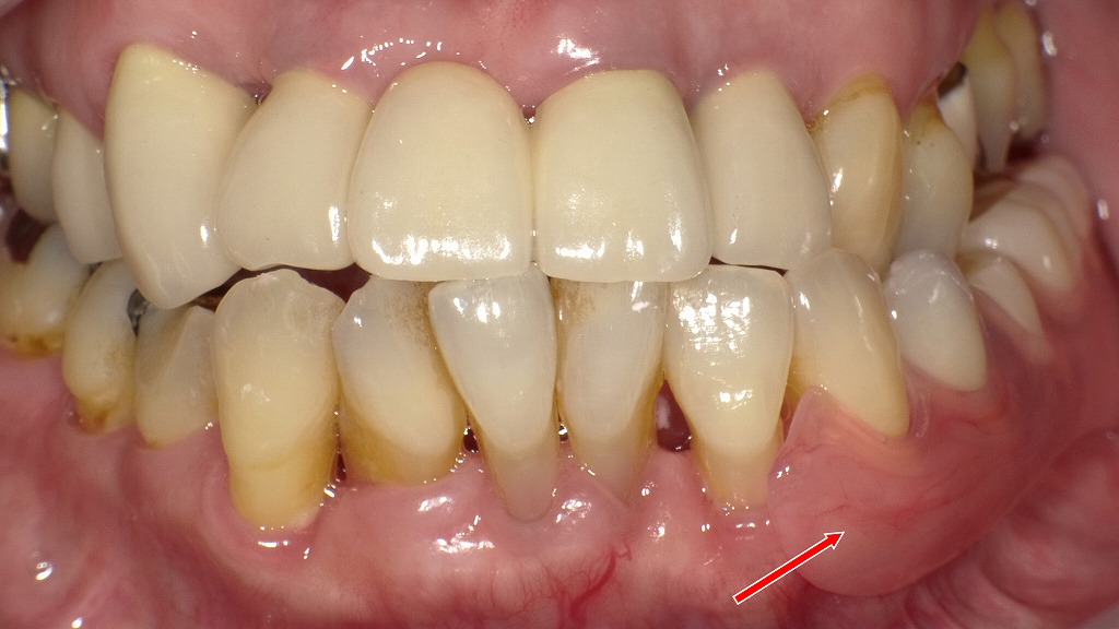 左下臼歯部C4抜歯後、ノンクラスプデンチャーによる補綴治療例
― 上顎はメタルボンドクラウンで再製作 ―