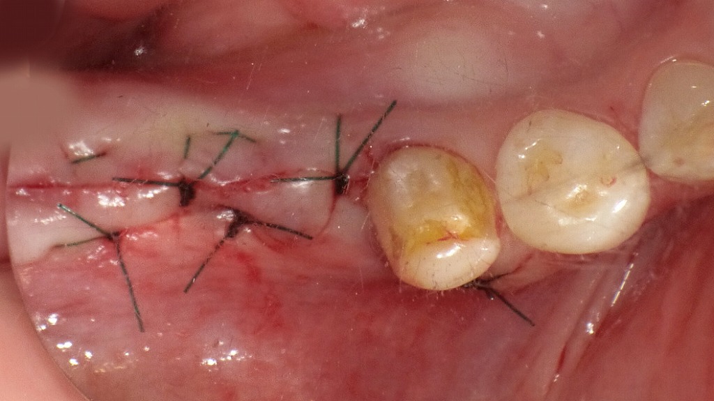 下顎6番・7番部のインプラント一次手術後の縫合所見。インプラント体を完全に粘膜下に埋入し、創部を安定させるために緊密な縫合を行っている。治癒を待ち、適切な骨結合が得られた段階で二次オペ（ヒーリングアバットメント装着）を予定。