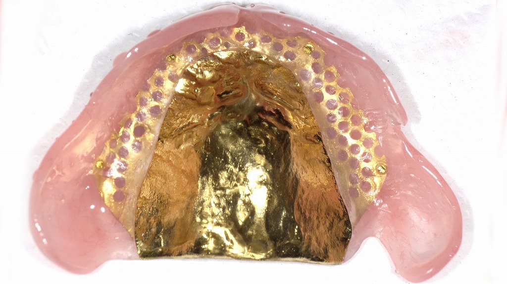 上顎金合金床:裏