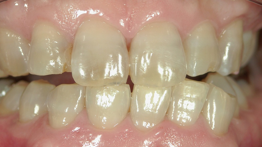 1枚目：ホワイトニング前