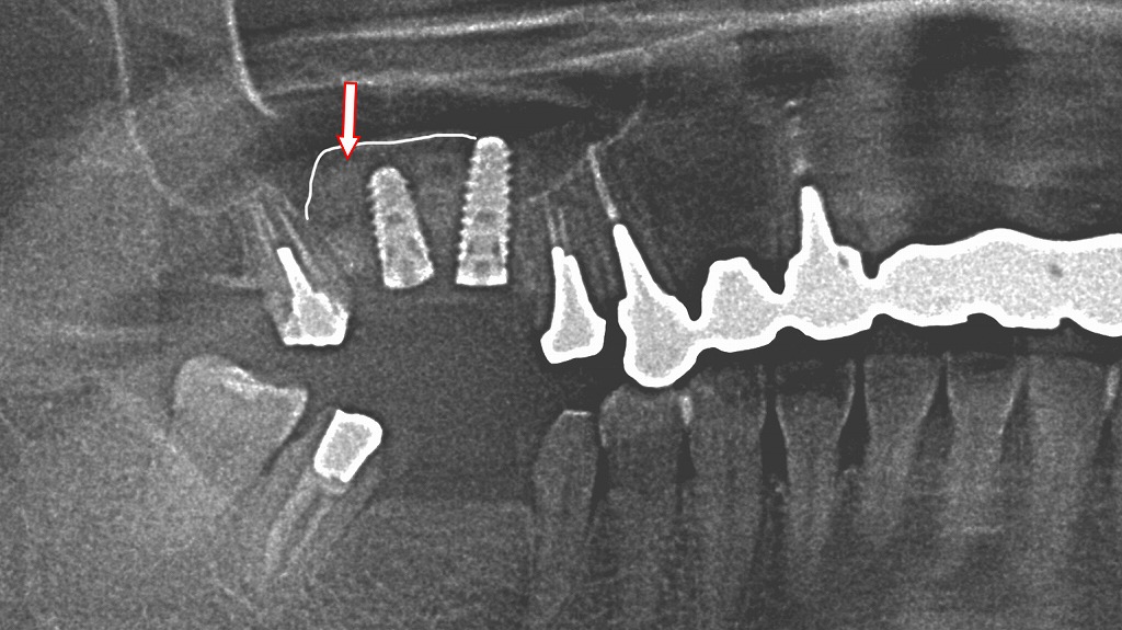 骨造成後にインプラント埋入