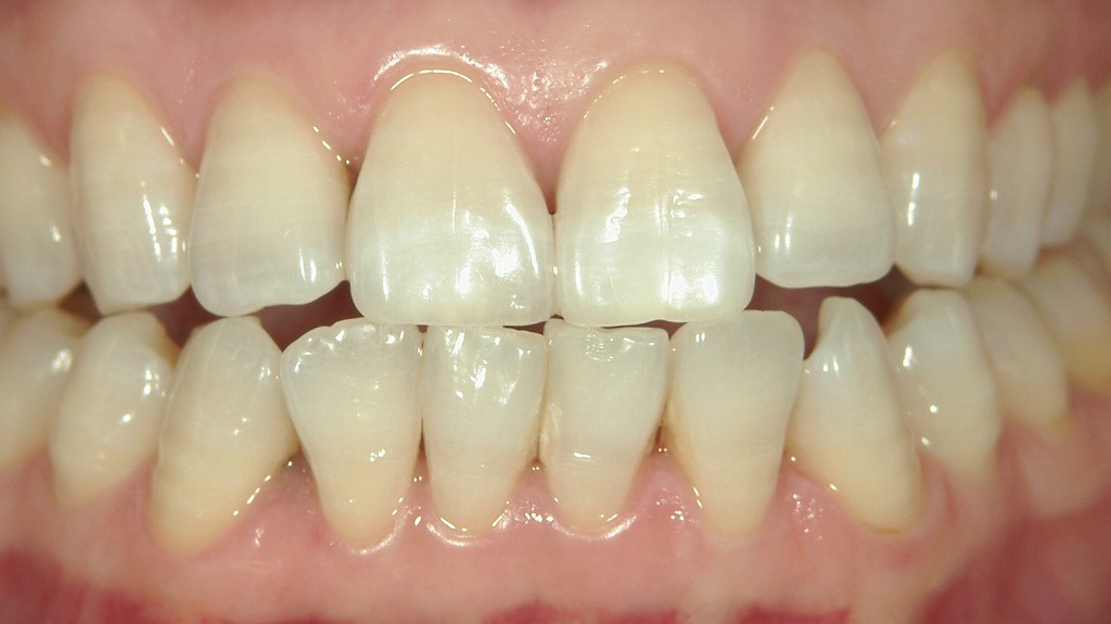 ２枚目：ホワイトニング後