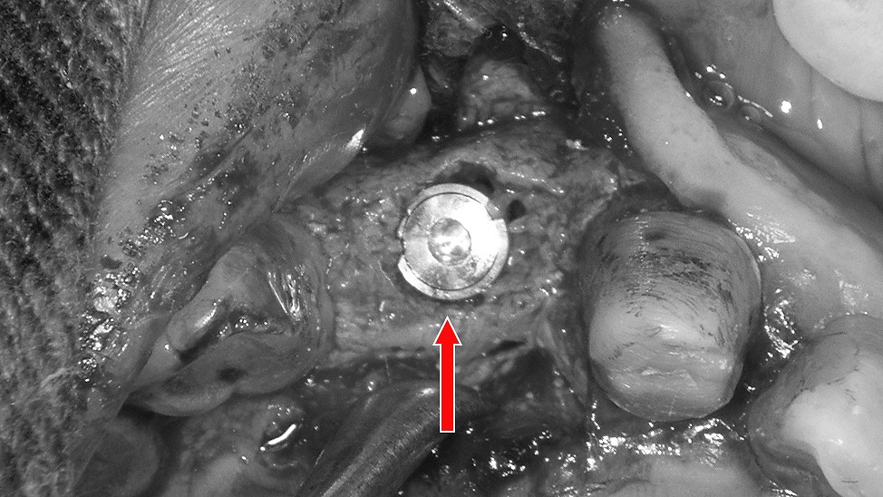 右上１番欠損にインプラント埋入