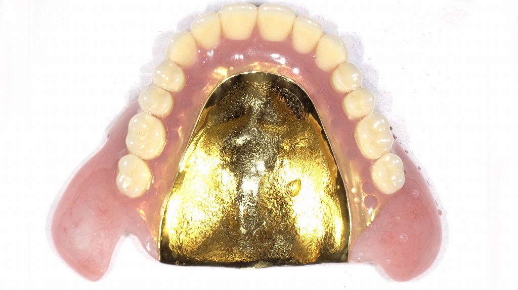 上顎金合金床:表