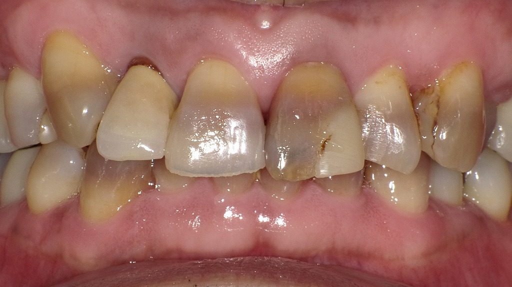 テトラサイクリン