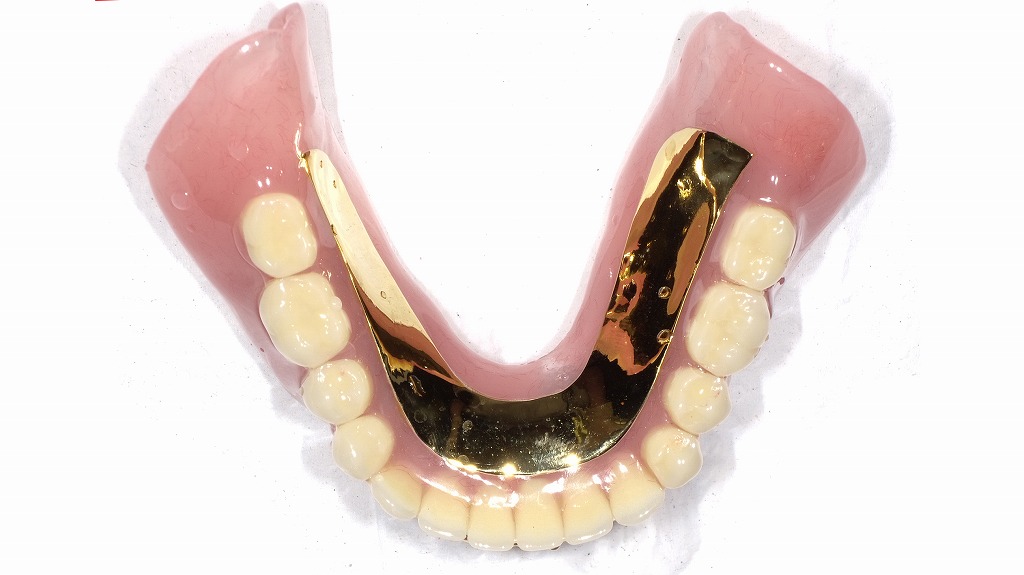 下顎金合金床:表