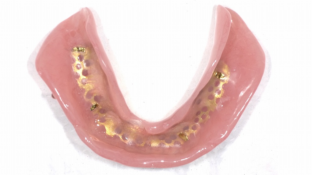 下顎金合金床:裏