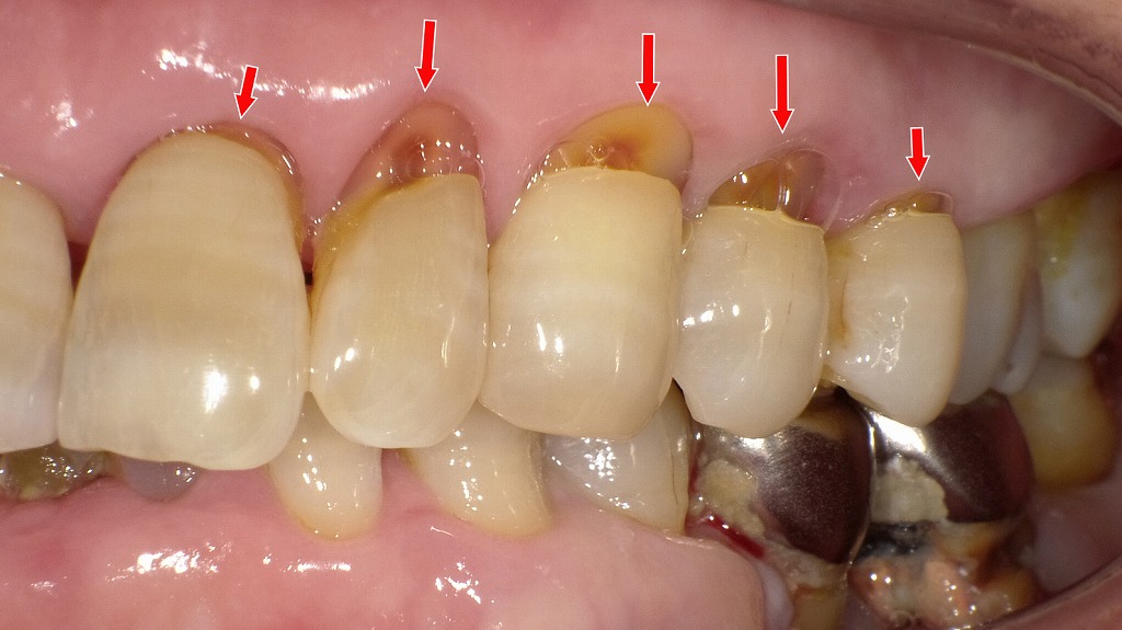 楔状欠損による歯根露出