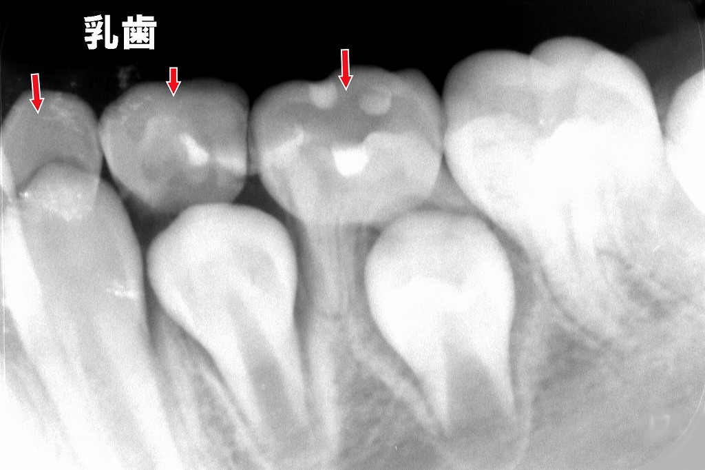 乳歯の根(歯根)が自然な吸収